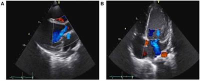 Fulminant Infective Endocarditis Due to Kingella Kingae and Several Complications in a 6-Year-Old Girl: A Case Report